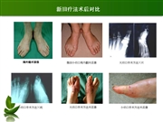中西医结合微创技术治疗拇外翻