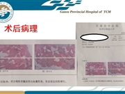 锁骨骨髓炎的治疗